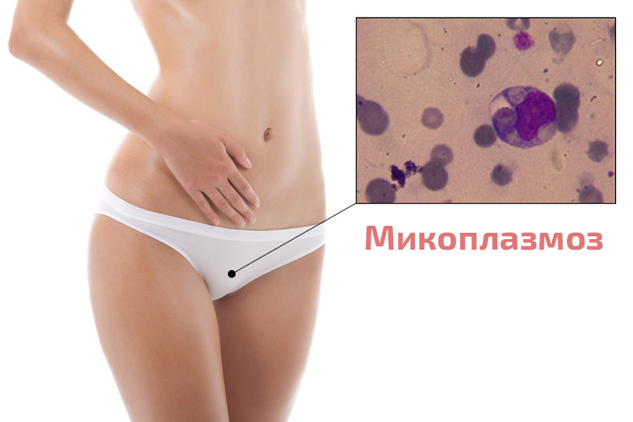 Могут ли микроплазмы привести к бесплодию